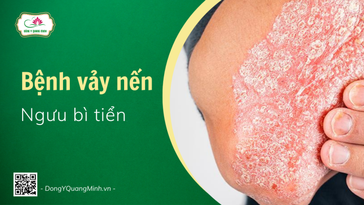 Bệnh Vảy Nến | Ngưu Bì Tiển