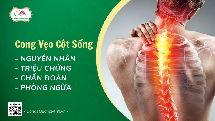 Cong Vẹo Cột Sống Là Gì?